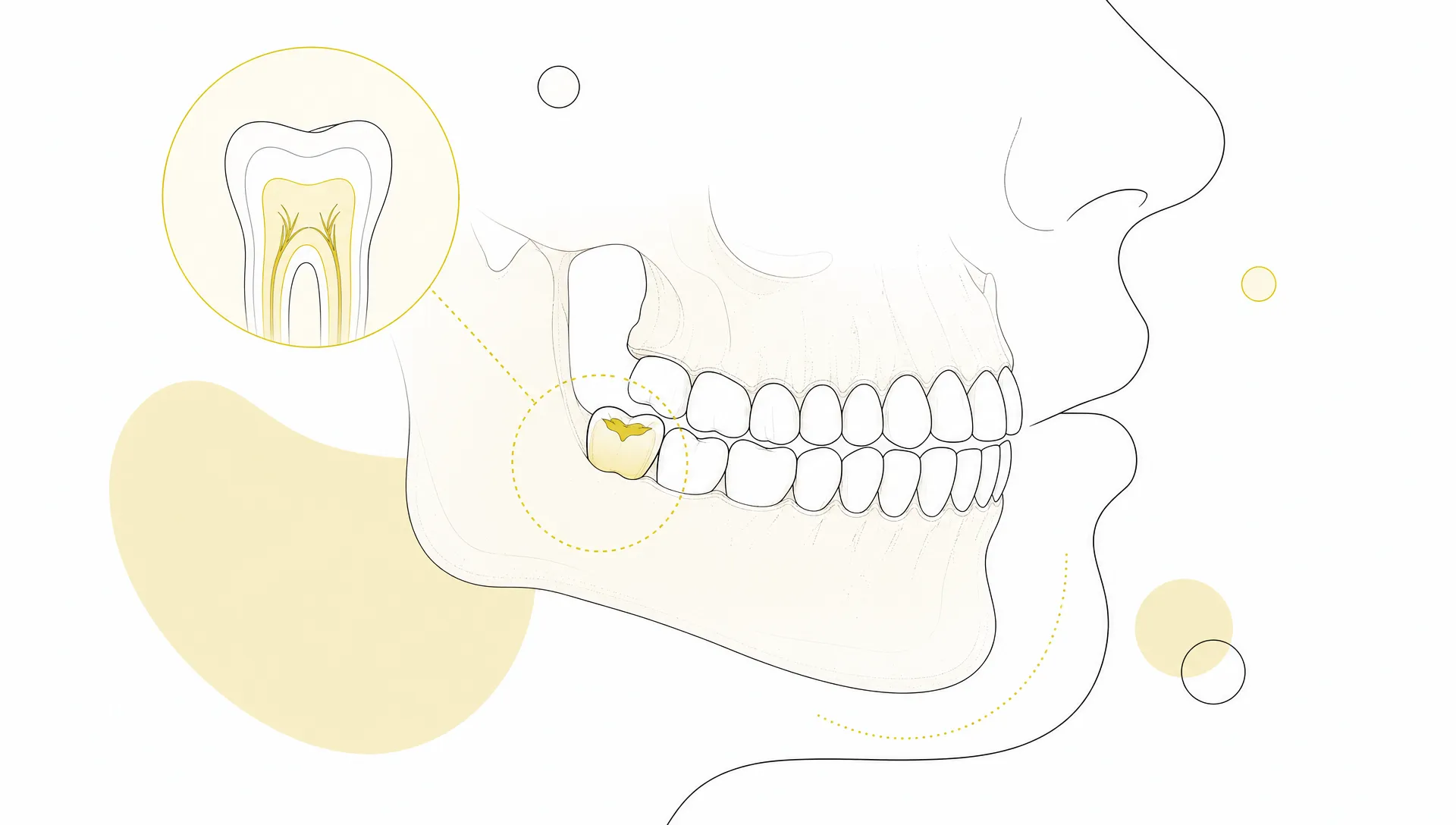 A side-view jaw highlights one molar as the focus for a dental filling decision.