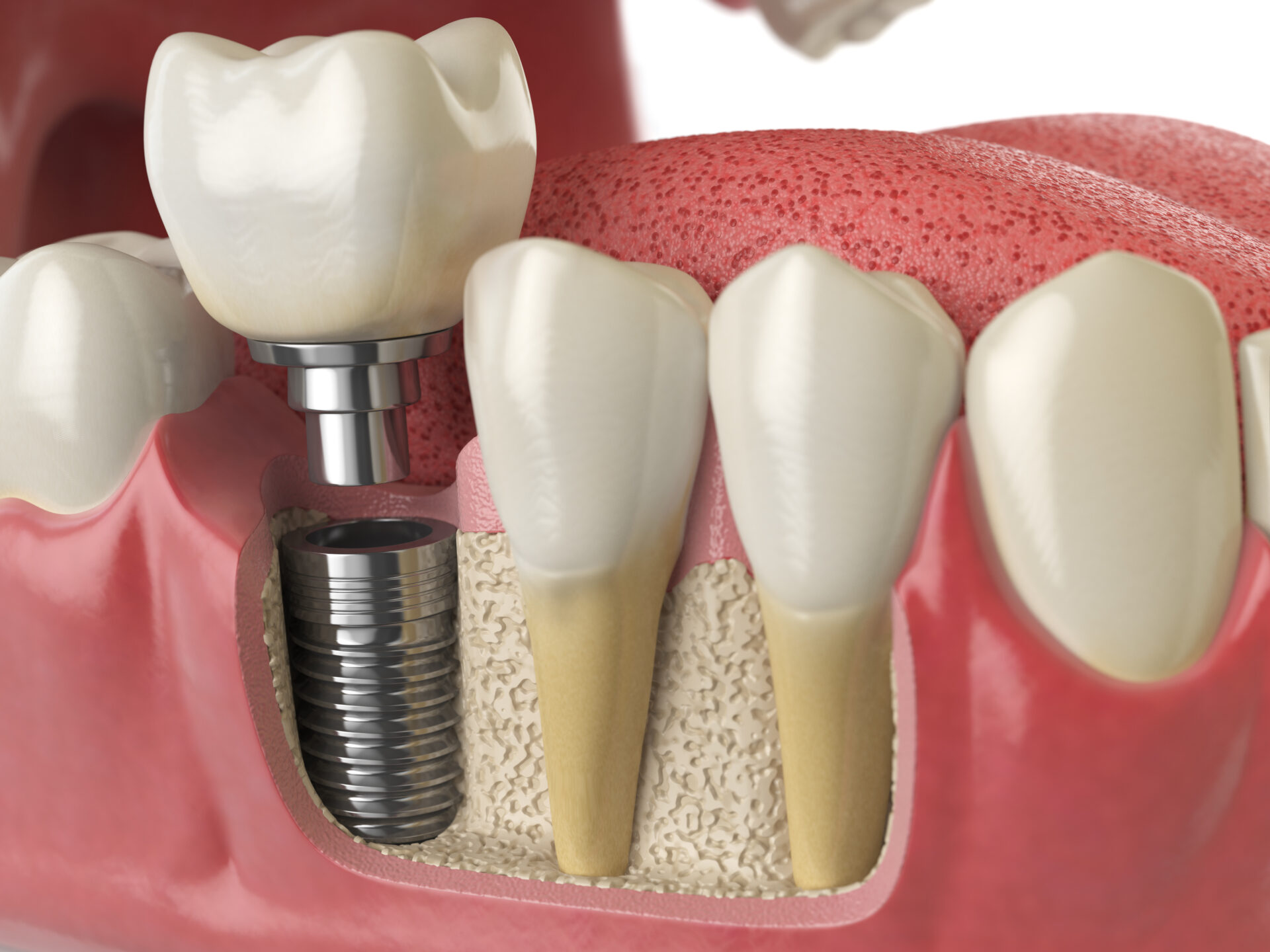 dental implant dentist in Toorak - Toorak Village Dental Care
