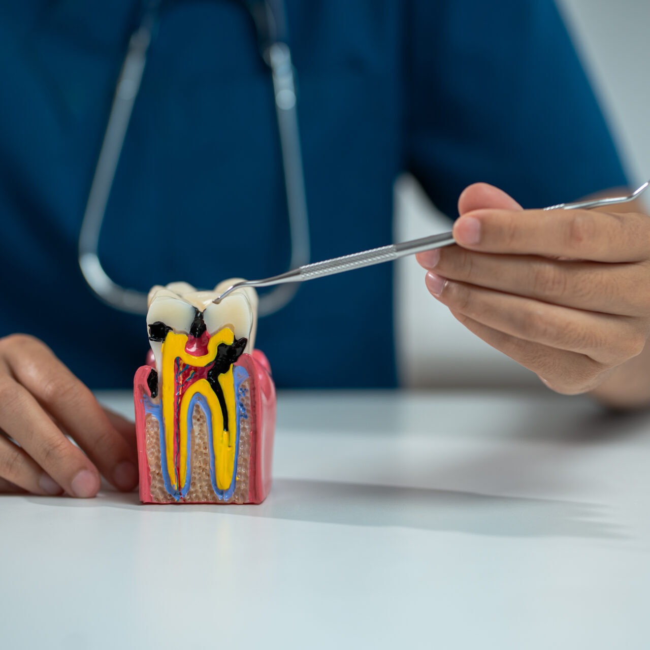 root canal treatment in toorak