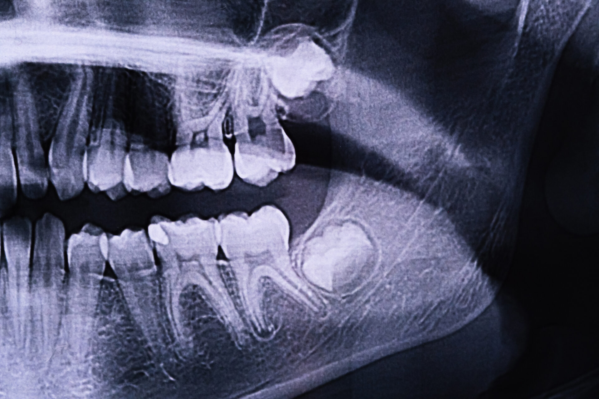 Wisdom Teeth Xray Smaple Image