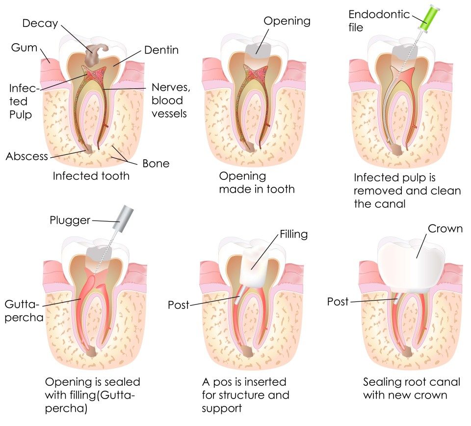 Endodontics (Root Canals) Infographic